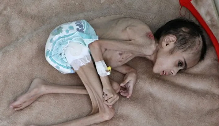 Yemen’deki durumun acı tablosu: 7 yaşındaki Faid Samim 7 kilogram ağırlığında