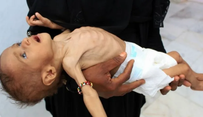 Yemen’de 5 yaş altı 400 bin çocuk yetersiz beslenme sebebiyle ölüm riski altında