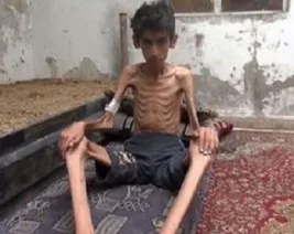 Madaya’da açlıktan ölümler artıyor